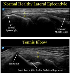 Ultrasound-of-Tennis-Elbow-283x300