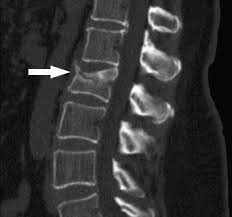 crollo-vertebrale (1)