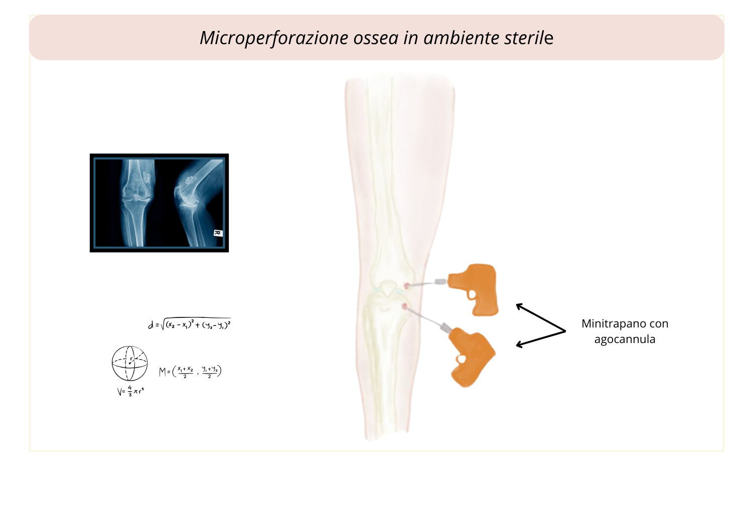 6) Microperforazione in ambiente sterile 3