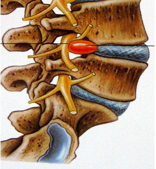 Le cause del mal di schiena