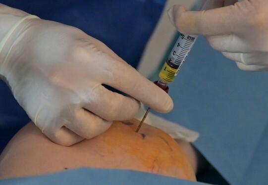 PRP che rigenera la tua schiena